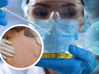 Tiêm vaccine đậu mùa có phòng được bệnh đậu mùa khỉ không?